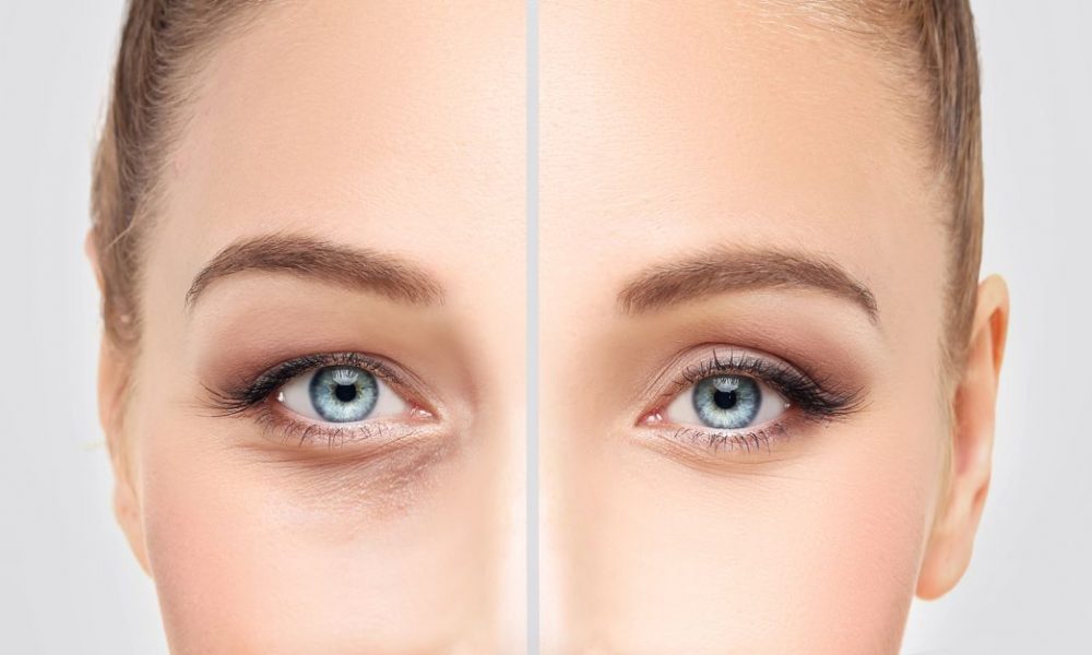 blefaroplastie