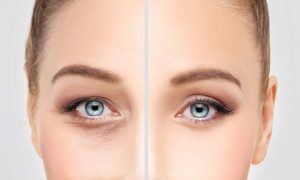 blefaroplastie