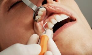 terapie cu dinți ficși